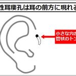 先天性耳瘻孔は耳の前方に現れる