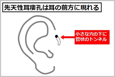 先天性耳瘻孔は耳の前方に現れる