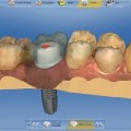 セラミック歯が1日で治療完了するデジタル歯科