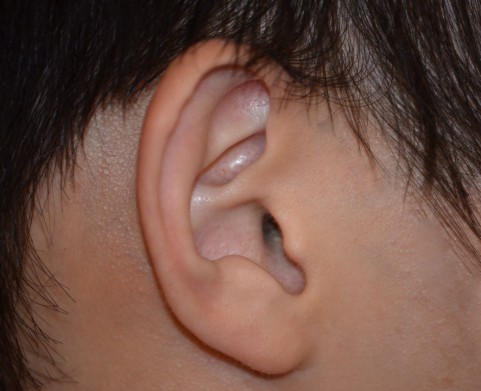 大人の中耳炎「滲出性中耳炎」症状と見分け方
