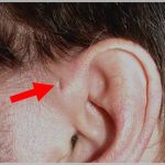 先天性耳瘻孔の外観