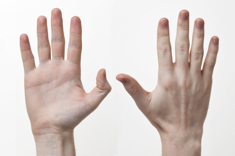 甲状腺機能亢進症の症状は伸ばした手でわかる