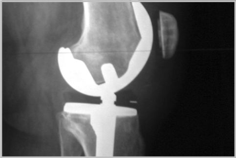変形性膝関節症の手術は最終的の手段が人工関節