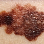 melanoma (480×334)