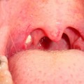 臭玉は食べかすではなく扁桃で繁殖した細菌の塊