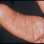 掌蹠膿疱症の画像