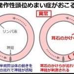 良性発作性頭位めまい症